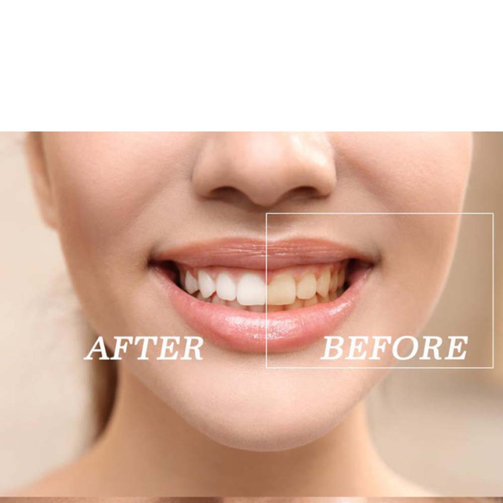 Top Quality Peroxide Teeth Whi - Teeth Whitening Kit ulasan dan harga